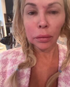 Everything Brandi Glanville Has Said About Her Facial Disfigurement Instagram