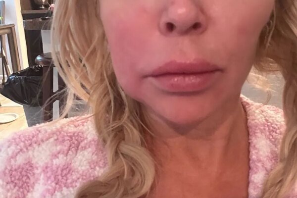 Everything Brandi Glanville Has Said About Her Facial Disfigurement Instagram