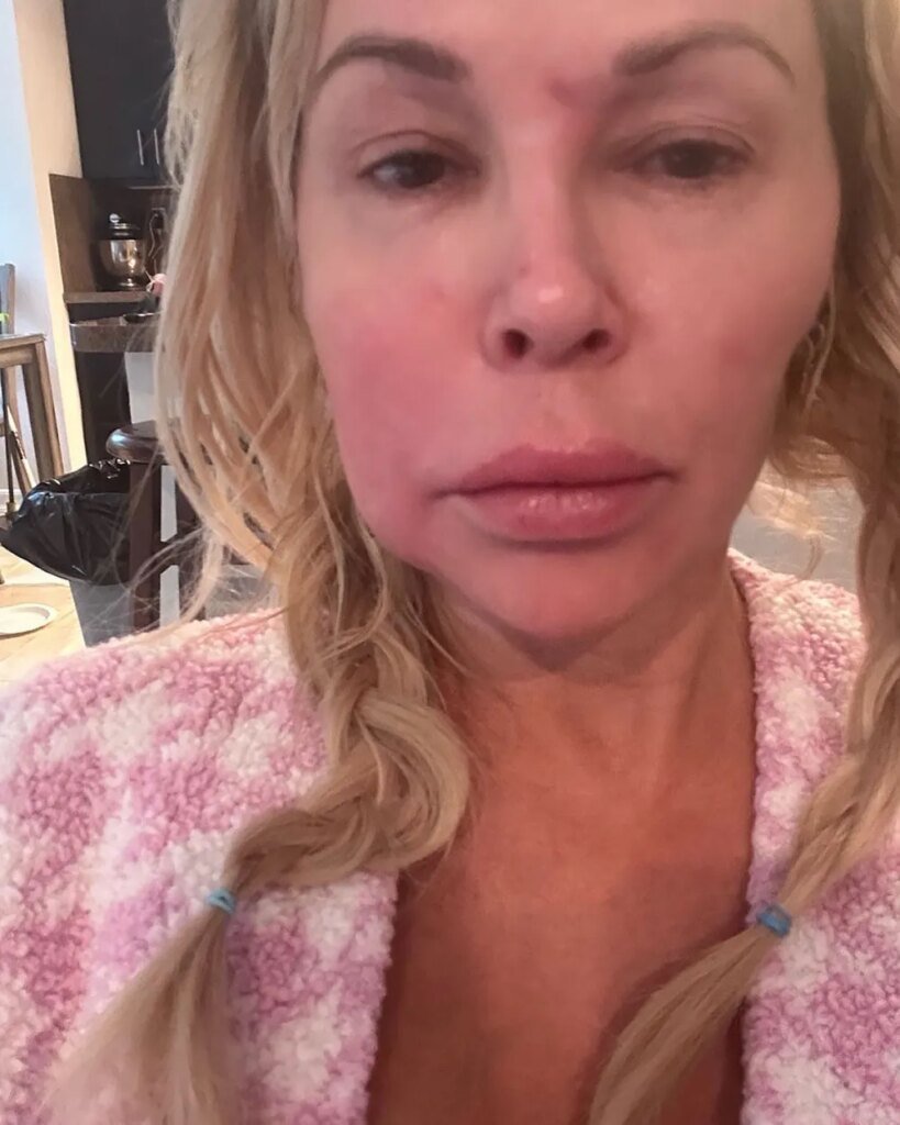 Everything Brandi Glanville Has Said About Her Facial Disfigurement Instagram